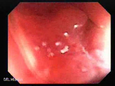 Rectal Adenocarcinoma - Colonoscopy (4 of 8)