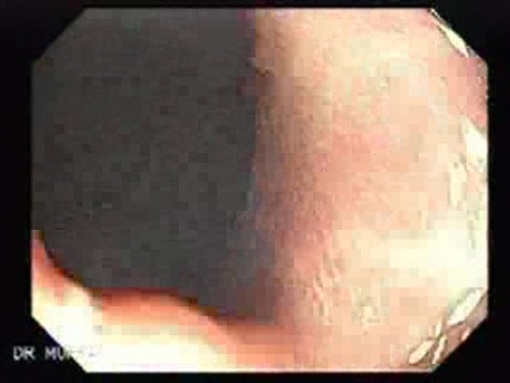 Multiple Gastric Angiodysplasia (17 of 17)