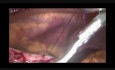 Laparoscopic Intragastric Surgery (LIGS): How I Do It