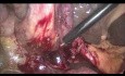Post ERCP Laparoscopic Cholecystectomy 