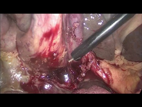 Post ERCP Laparoscopic Cholecystectomy 