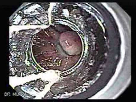 Dieulafoy´s Lesion (Exulceratio Simplex) (6 of 9)