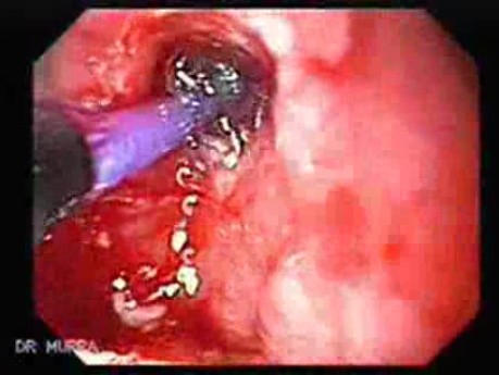 Gastric Cicatrization With Pylorus Stenosis (3 of 23)