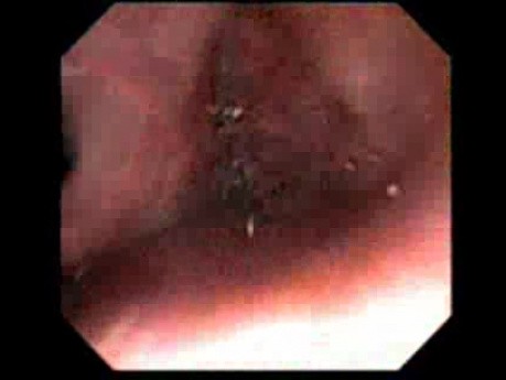 Retroflexion Maneuver Out Of Patient's Body - Endoscopic View Of The Nasal Cavity