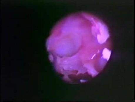Functional Endoscopic Sinus Surgery - Anatomical Demostration - Part 4 of 5