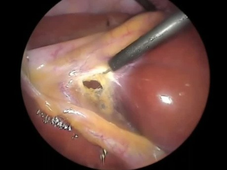 The Critical View of Safety During Laparoscopic Cholecystectomy