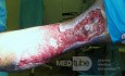 Atrophic Lower Leg Ulceration - Stage I
