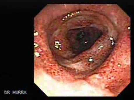 Ulcerative Colitis Complicating Pseudomembranous Colitis (2 of 4)