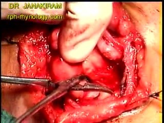 Warthin's tumor