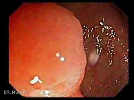 Giant Tubulo - Villous Adenoma (2 of 17)