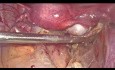 Bilateral Dermoid Cyst Excision in Endobag