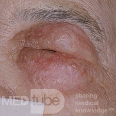 Pre-Septal Orbital Edema Secondary to Acute Anterior Ethmoid Sinus Infection