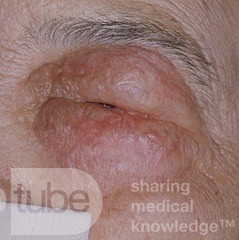 Pre-Septal Orbital Edema Secondary to Acute Anterior Ethmoid Sinus Infection