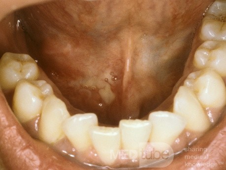 Purulent Discharge Left Submandibular Gland