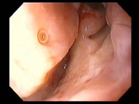 Massive Epistaxis - After Alcohol Ablation Status - 8/8