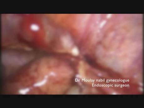 Emergency Laparoscopy for Ruptured Ectopic Pregnancy