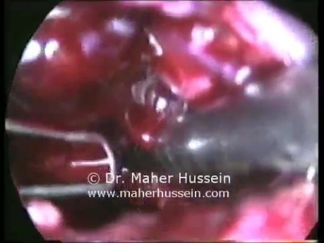 Complicated gastric band treatment