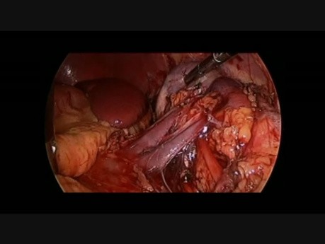 Laparoscopic partial left nephrectomy in 5-year-old girl