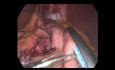 3 Trocars Gastric Bypass