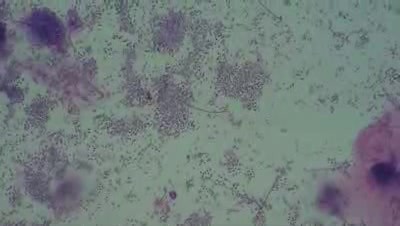 Bacterial vaginosis - Leptothrix