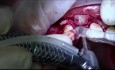 Placement of Implants 12, 22 with Guided Bone Regeneration