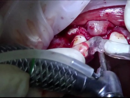 Placement of Implants 12, 22 with Guided Bone Regeneration