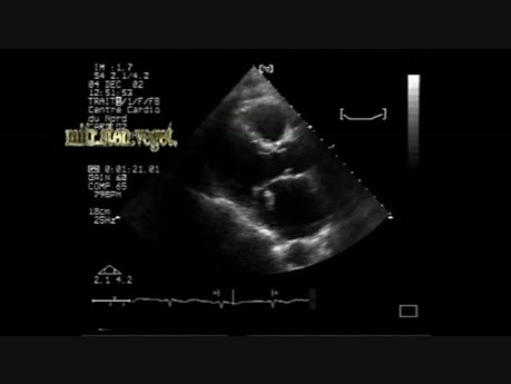 Infective Endocarditis on Mitral Stenosis 1