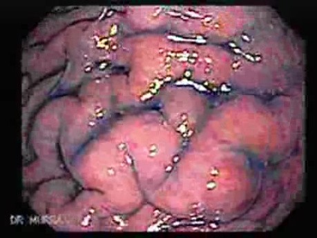 Scirrhous Gastric Carcinoma - Endoscopy (3 of 15)