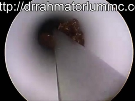 How to Remove The Hardened Crusts From a Blocked T-Tube