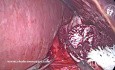 Mastering Heller Myotomy: Preserving the Anterior Vagus Nerve During Laparoscopic Heller Myotomy