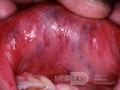 Vascular Malformation of the Lip