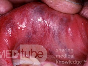 Vascular Malformation of the Lip