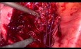 Laparoscopic Myomectomy