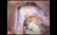 Pineal tumor Surgery - Subtentorial Supracerebellar Approach