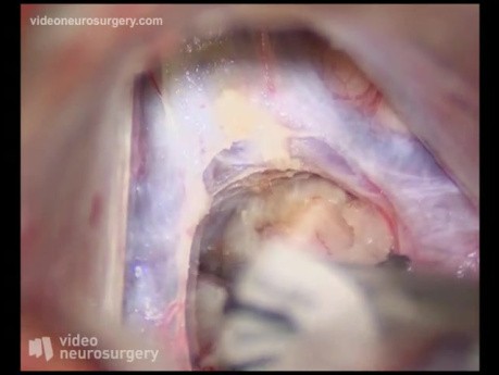 Pineal tumor Surgery - Subtentorial Supracerebellar Approach