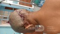 Epicranial Lesion Completely Resected Without Complications
