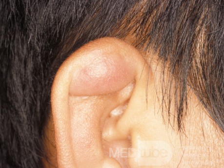 Traumatic Seroma of the Pinna
