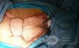Chemoresistant Triple Negative Breast Cancer - the Large Tissue Defect Was Filled with a Latissimus Dorsi Flap 