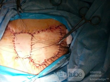 Chemoresistant Triple Negative Breast Cancer - the Large Tissue Defect Was Filled with a Latissimus Dorsi Flap 