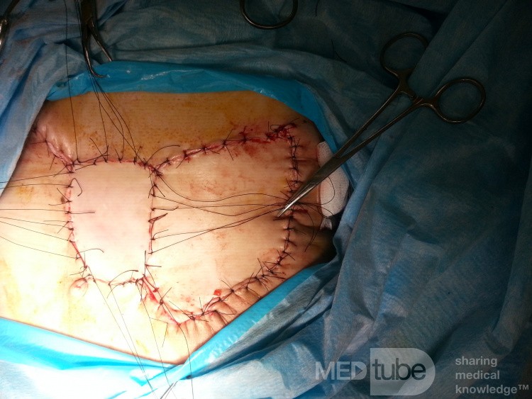Chemoresistant Triple Negative Breast Cancer - the Large Tissue Defect Was Filled with a Latissimus Dorsi Flap 