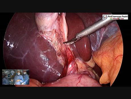 Safe Way of Performing Laparoscopic Cholecystectomy