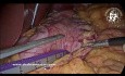 Sleeve Gastrectomy in Case of Pneumatosis Intestinalis