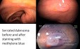Serrated adenoma