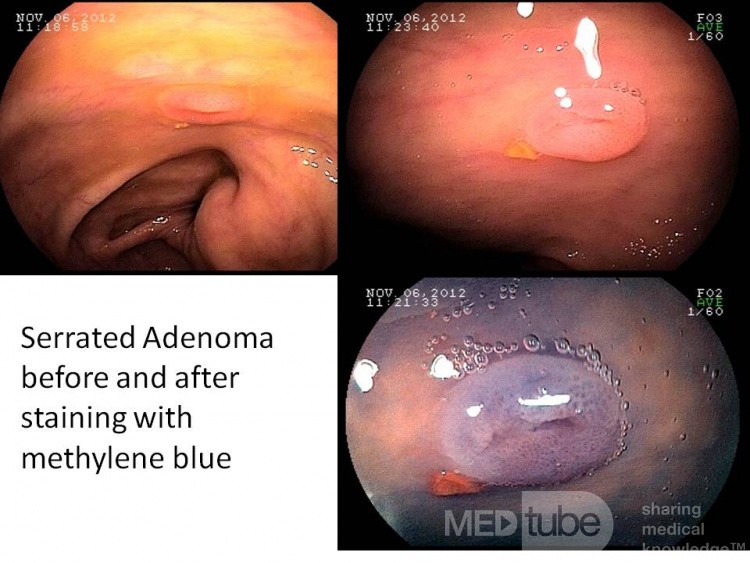 Serrated adenoma