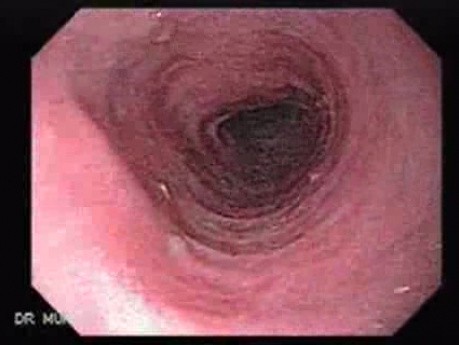 Esophageal Candidiasis Infected with Bacteria - 58 Years-Old Male