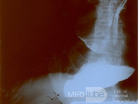 Esophageal Achalasia  (4 of 16)