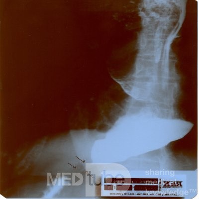 Esophageal Achalasia  (4 of 16)