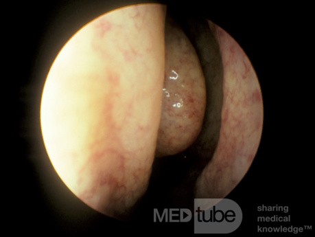 The Ethmoidal Bulla [Right]