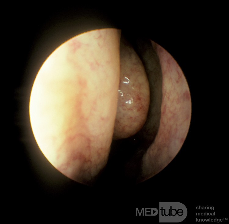 The Ethmoidal Bulla [Right]