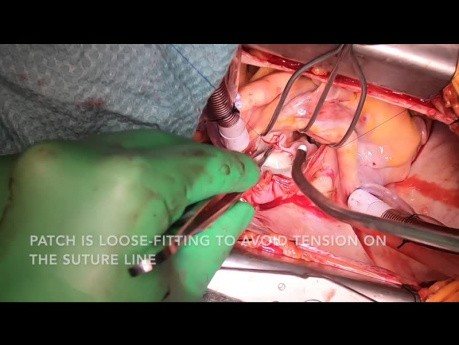 Mitral Valve Replacement with Patch Repair of Posterior Annulus and CABGx1